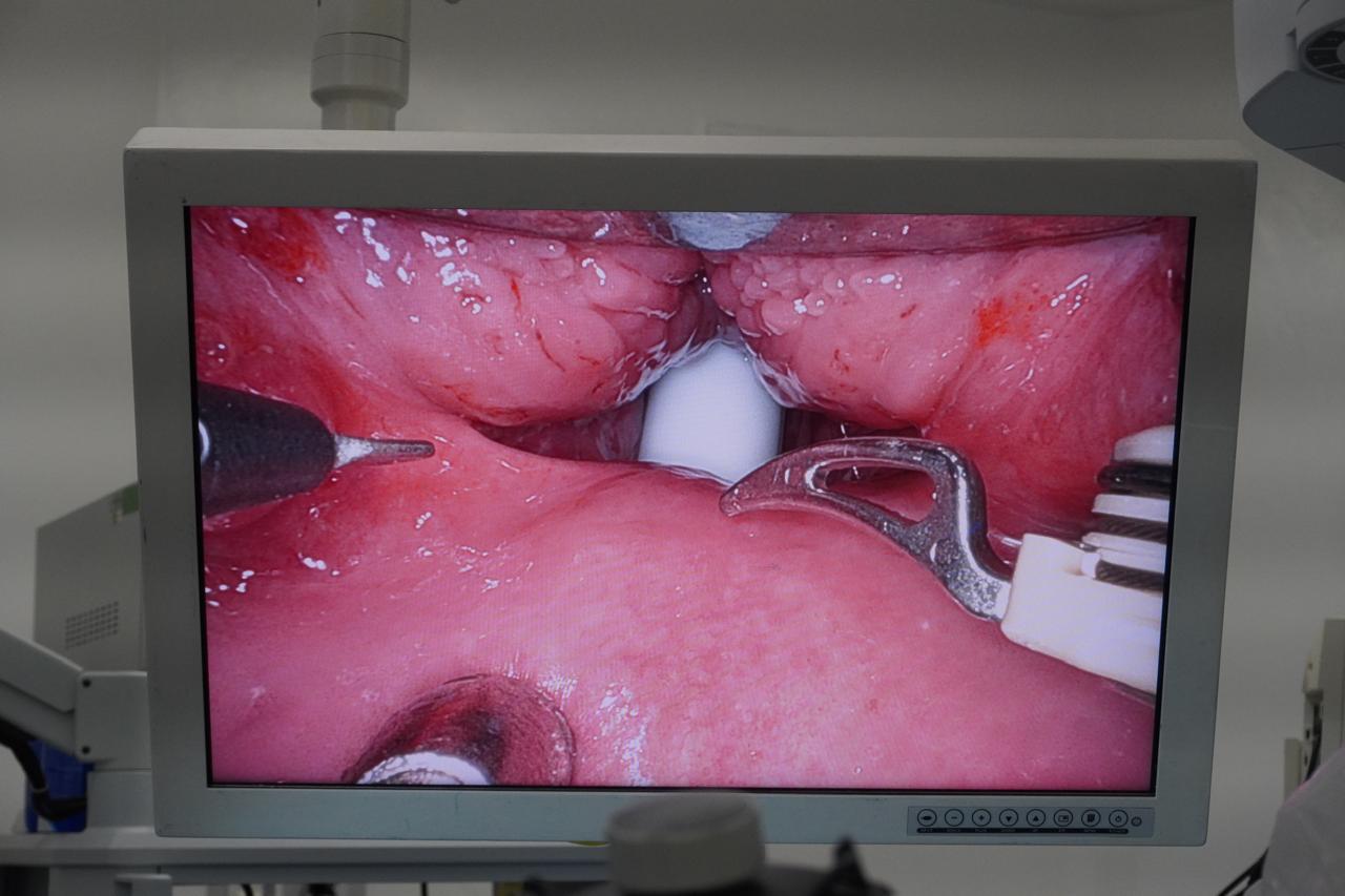 Visualização ampliada da região tratada durante cirurgia robótica